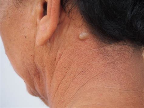 can sebaceous cysts turn cancerous.